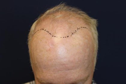 Hair Restoration Before & After Patient #6153