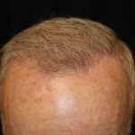 Hair Restoration Before & After Patient #6153