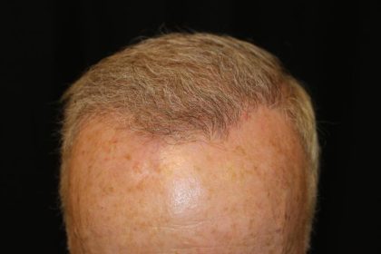 Hair Restoration Before & After Patient #6153
