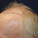 Hair Restoration Before & After Patient #6153