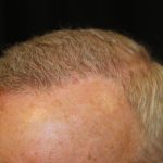 Hair Restoration Before & After Patient #6153