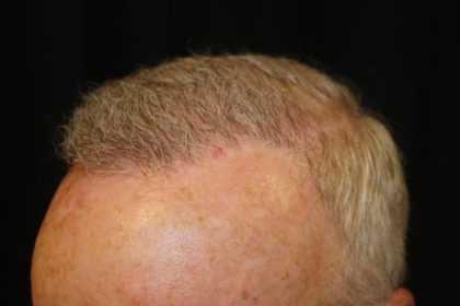 Hair Restoration Before & After Patient #6153