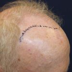 Hair Restoration Before & After Patient #6153