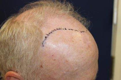 Hair Restoration Before & After Patient #6153