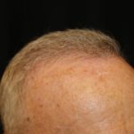 Hair Restoration Before & After Patient #6153