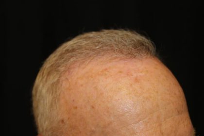 Hair Restoration Before & After Patient #6153