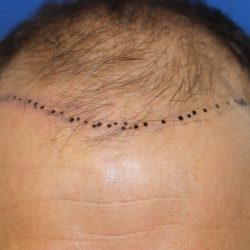 Hair Restoration Before & After Patient #6156