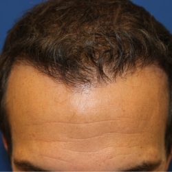 Hair Restoration Before & After Patient #6156