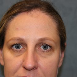 Blepharoplasty Before & After Patient #6221