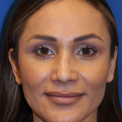 Rhinoplasty Before & After Patient #6229