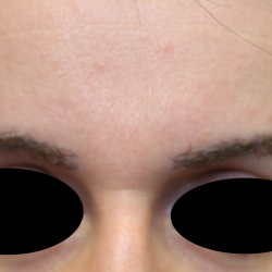 Eyebrows Before & After Patient #6300