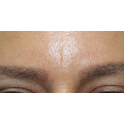 Eyebrows Before & After Patient #6299