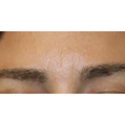 Eyebrows Before & After Patient #6299