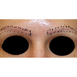Eyebrows Before & After Patient #6327