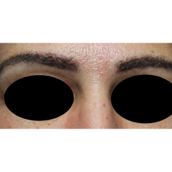 Eyebrows Before & After Patient #6327