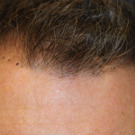 Hair Restoration Before & After Patient #6351