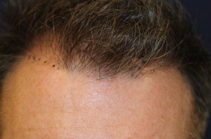 Hair Restoration Before & After Patient #6351