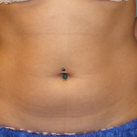 Liposuction Before & After Patient #6333