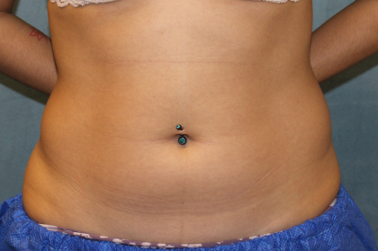 Liposuction Before & After Patient #6333
