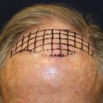 Hair Restoration Before & After Patient #6344