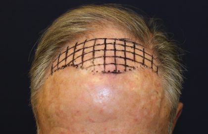 Hair Restoration Before & After Patient #6344