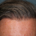 Hair Restoration Before & After Patient #6351