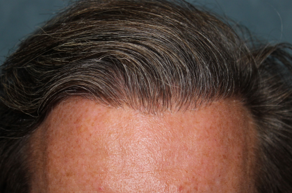 Hair Restoration Before & After Patient #6351