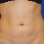 Liposuction Before & After Patient #6333
