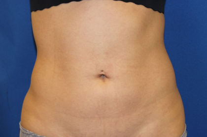 Liposuction Before & After Patient #6333