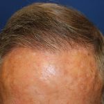 Hair Restoration Before & After Patient #6344