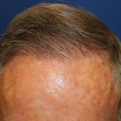 Hair Restoration Before & After Patient #6344