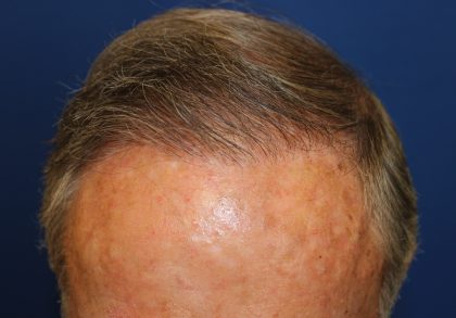 Hair Restoration Before & After Patient #6344