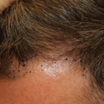 Hair Restoration Before & After Patient #6351