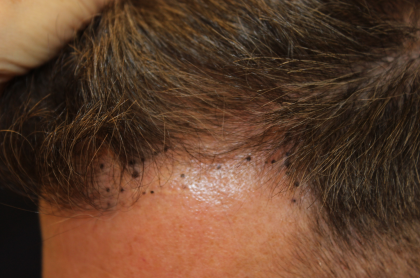 Hair Restoration Before & After Patient #6351