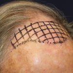 Hair Restoration Before & After Patient #6344
