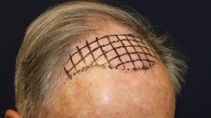 Hair Restoration Before & After Patient #6344