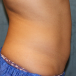 Liposuction Before & After Patient #6333