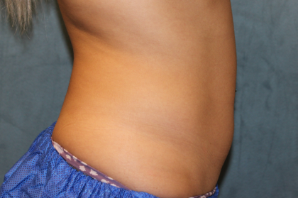 Liposuction Before & After Patient #6333