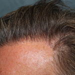 Hair Restoration Before & After Patient #6351
