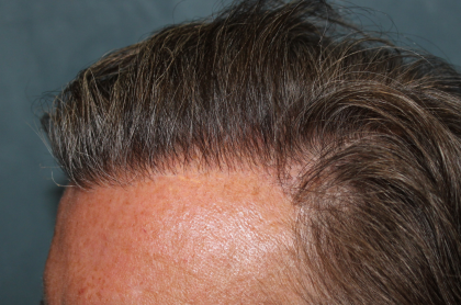 Hair Restoration Before & After Patient #6351