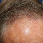 Hair Restoration Before & After Patient #6344