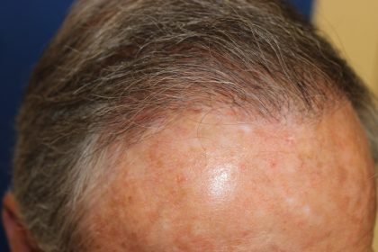 Hair Restoration Before & After Patient #6344