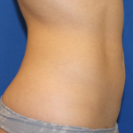Liposuction Before & After Patient #6333
