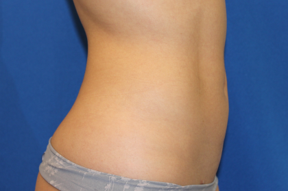 Liposuction Before & After Patient #6333