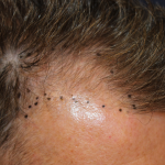 Hair Restoration Before & After Patient #6351