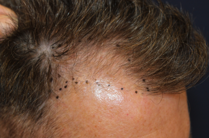 Hair Restoration Before & After Patient #6351
