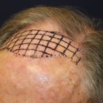 Hair Restoration Before & After Patient #6344