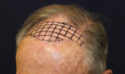 Hair Restoration Before & After Patient #6344