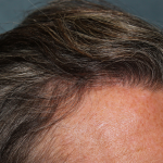 Hair Restoration Before & After Patient #6351
