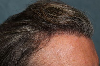 Hair Restoration Before & After Patient #6351